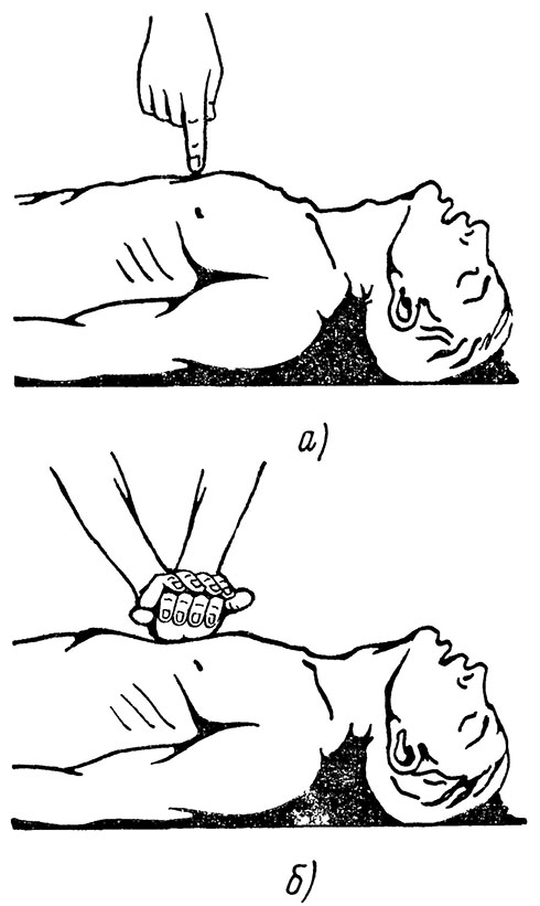 Наружный (непрямой) массаж сердца