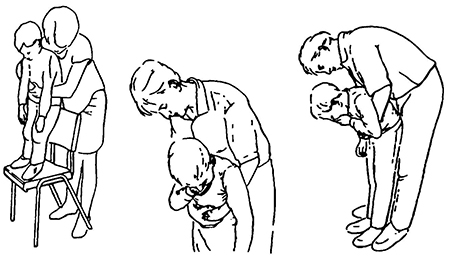 Прием Геймлиха в положении ребенка стоя