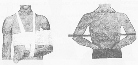 Иммобилизация при переломах ключицы